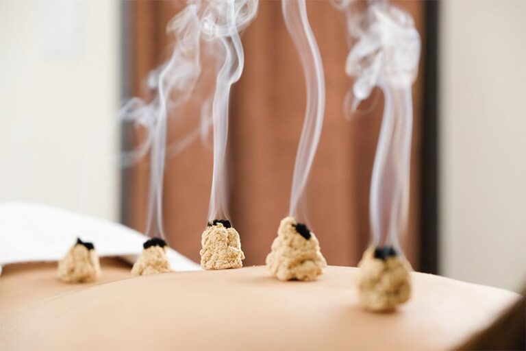 Moxibustion in Torquay